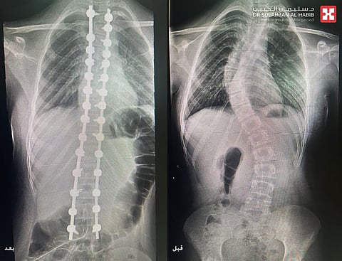 مجمع الدكتور سليمان الحبيب بالعليا يُنهي معاناة فتاة 13 عام مع الجنف المضاعف بتقنيات الذكاء الاصطناعي AI