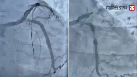 مستشفى الدكتور سليمان الحبيب بالخبر ينقذ حياة مراجع توقف قلبه بسبب انسداد كلي للشريان النازل