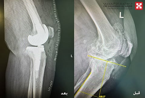 مستشفى الدكتور سليمان الحبيب بالخبر يُجري عملية زراعة مفصل معقدة بتقنية "الروبوت الجراحي" لإعادة قدرة المشي لثمانينية