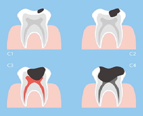 ليست الحلويات فقط.. طبيب بريطاني: أطعمة ومشروبات غير متوقعة تسبب تسوس الأسنان