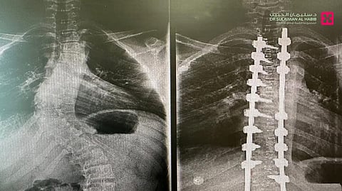 مستشفى الدكتور سليمان الحبيب بالفيحاء ينجح في تصحيح ميلان حاد بالعمود الفقري لشاب