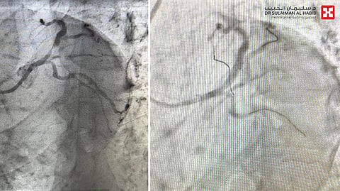 مستشفى الدكتور سليمان الحبيب بالمحمدية في جدة يُنقذ مراجع مصاب بانسداد حاد نسبته "99%" بالشريان التاجي الأيسر
