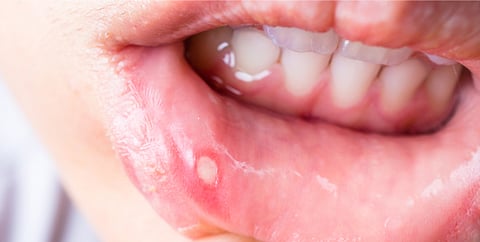 من نقص الفيتامينات إلى أمراض المناعة.. متى تصبح قروح الفم ناقوس خطر؟
