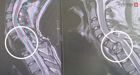 مستشفى الدكتور سليمان الحبيب بالقصيم ينقذ شاب تعرض لحادث مروري من الشلل المحتم بجراحتين معقدتين