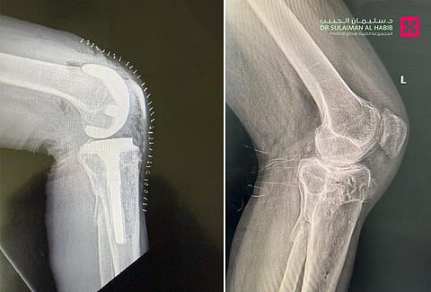 مجمع الدكتور سليمان الحبيب بالعليا يجري عملية استبدال للركبة باستخدام مفصل مطبوع بالتقنية ثلاثية الأبعاد