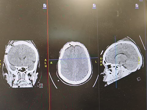 إنقاذ حياة شاب تعرّض لنزيف حاد في الدماغ إثر حادث مروري بمستشفى الأمير عبدالمحسن بالعلا