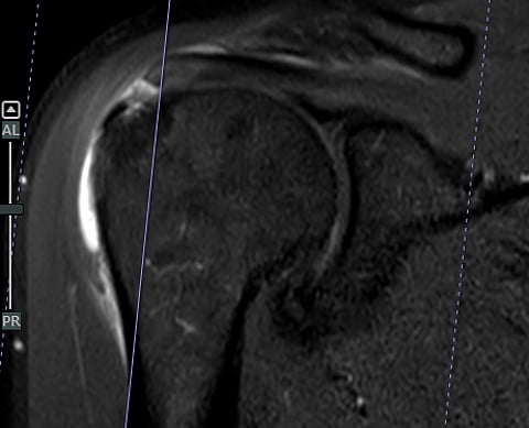 مريض يستعيد كامل حركة كتفه بواسطة تقنية طبية متقدمة في مستشفيات المانع بالخبر
