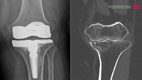 مستشفى الدكتور سليمان الحبيب بالفيحاء في جدة يجري جراحة معقدة لاستئصال ورم واستبدال مفصل الركبة لأربعينية