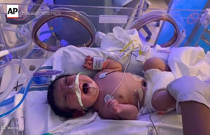 "حالة أقل من واحد في المليون".. ولادة طفل معجزة بعد حمل في كيس ملتصق بالكبد