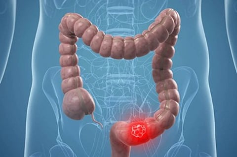 دراسة: أدوية الكوليسترول يمكن أن تقلل الإصابة بسرطان القولون بنسبة 23 %