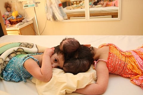 إجراء عملية الفصل للتوأمين السياميين السعوديين "رنا ورنيم".. غداً