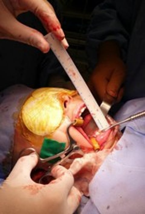 "فريق طبى" ينجح في إعادة البسمة والكلام لطفلة بالرياض