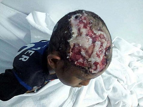 الشؤون الاجتماعية تباشر حالة طفل مسلوخ الرأس في مستشفى جازان