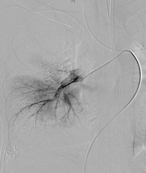 فريق بمستشفى النور يساهم في إنقاذ حياة "عشريني" بعملية نادرة