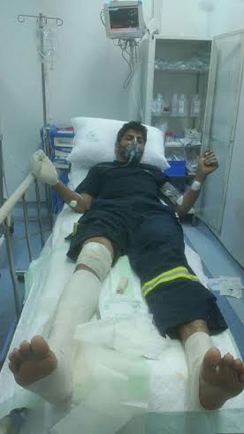 إصابة رجل دفاع مدني بحروق أثناء تأدية واجبه في الباحة