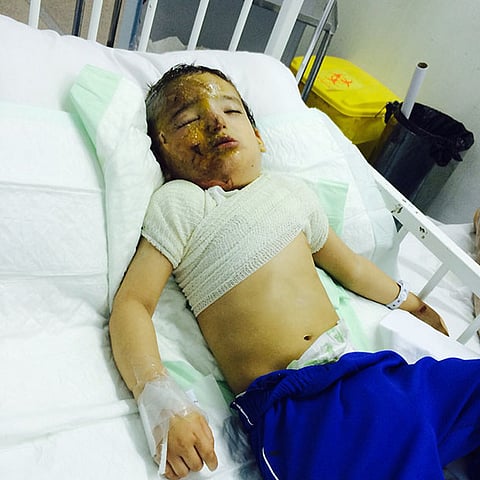 عم طفل محروق يشتكي مستشفى العقيق إلى وزير الصحة