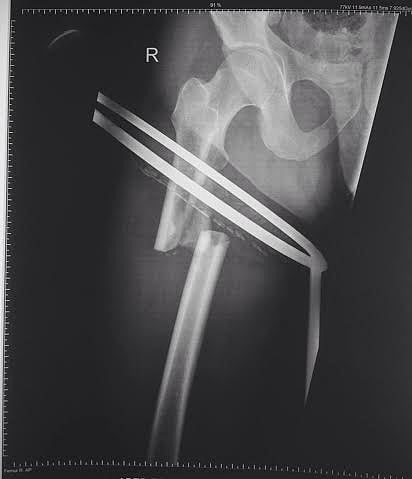 مستشفى القويعية ينجح في تثبيت كسر فخذ مصاب دون جراحة