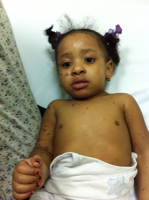 "شرطة مكة المكرمة": أطراف قضية "الأسيد" منوَّمون بالمستشفى