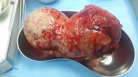 في إنجاز طبي بالرياض .. استئصال ورم سرطاني يزن 1700 جرام