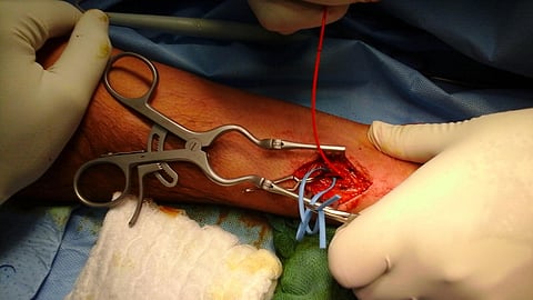 جراحة ناجحة بتخصصي سكاكا تنقذ يد أربعيني من البتر