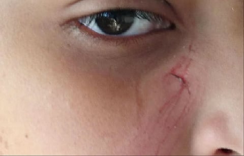 لجنة تحقق مع معلم ضرب طالباً بالطائف.. ووالده يروي: آثار دماء