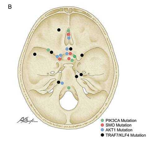 فريق بحثي من المملكة وهارفارد يحدد "جيناً هاماً" لأورام الدماغ السحائية