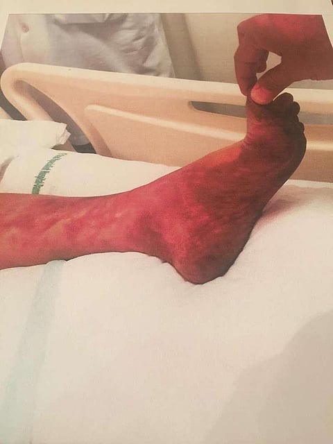 قضية بتر قدم الثلاثينية بالدمام تحال للهيئة الشرعية وزوجها يكشف عن مفاجأة