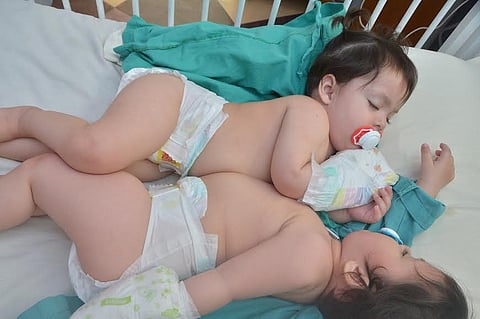 نجاح فصل السيامي الباكستاني "فاطمة ومشاعل" .. والربيعة: سابقة عالمية