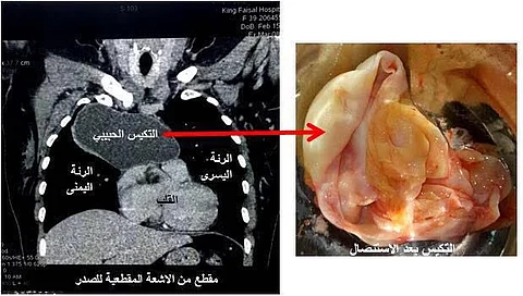 استئصال "تكيُّس" نادر بصدر سورية بالطائف .. محفوظ: قد يكون الأكبر عالمياً