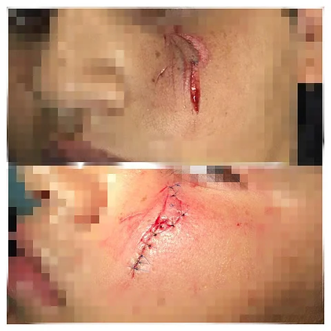 "تعليم جدة" يُنهي عَقْد معلِّم وافد أصاب طالبًا بـ12 غرزة في وجهه