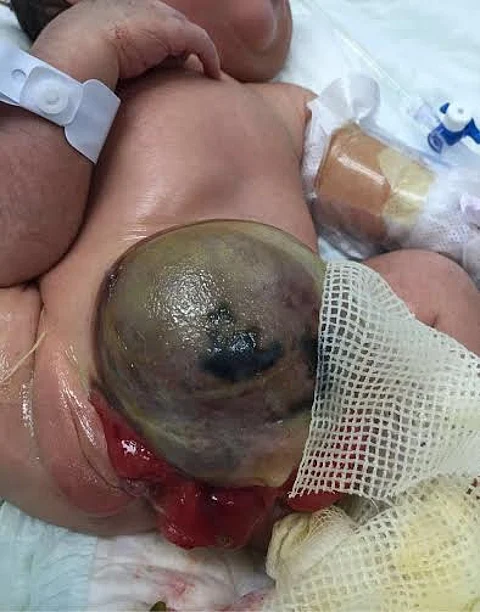 "جراحة الأطفال" بمستشفى الملك سلمان ينجح في إجراء عملية نادرة