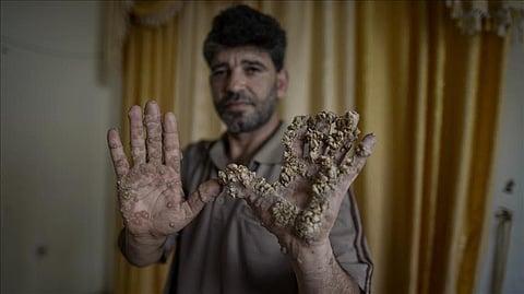 مرض نادر يصيب فلسطينياً ويحول يديه إلى "جذع شجرة"