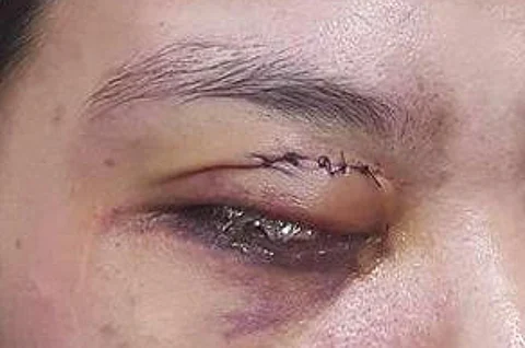 شرطة الخرج تحقق في اعتداء مواطن على ممرضة.. طعنة في العين