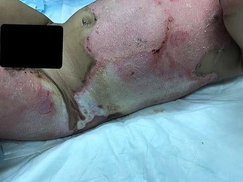 مأساة "سالم".. حروق طفل الـ 19 شهراً تبحث عن مستشفى يداويها