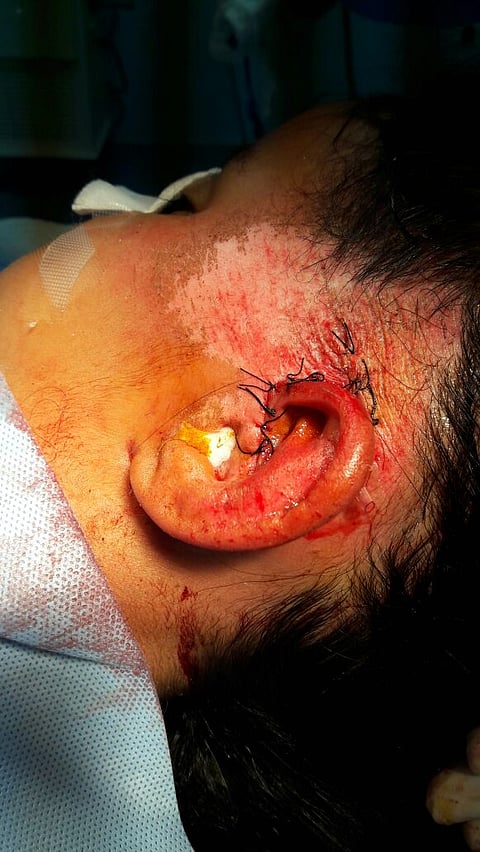 إعادة أذن طفلة لوضعها الطبيعي بمستشفى باللحمر