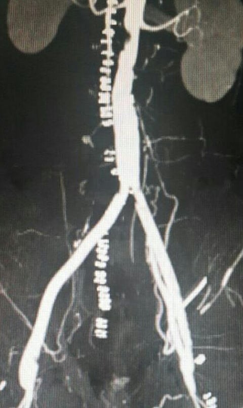 إجراء أول عملية تغيير شريان صناعي بمستشفى الملك فهد بالباحة