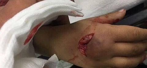 ذئب مفترس ينهش طفلاً ويتسبب في تنويمه بـ "مركزي عرعر"