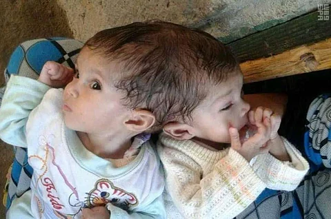بتوجيهات خادم الحرمين.. وصول التوأمين السياميين المصريين "منة ومي" إلى المملكة