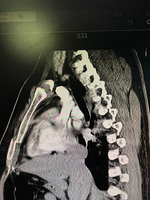 نجاح أول عملية تثبيت للقفص الصدري بمستشفى الملك فهد في الباحة
