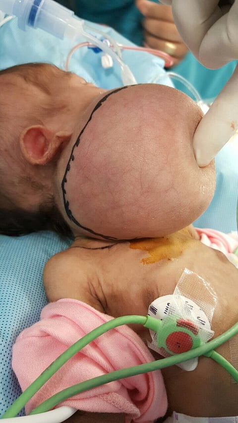 مكة .. جراحة نادرة ومعقدة تُزيل ورماً ببلعوم رضيعة الـ 45 يوماً