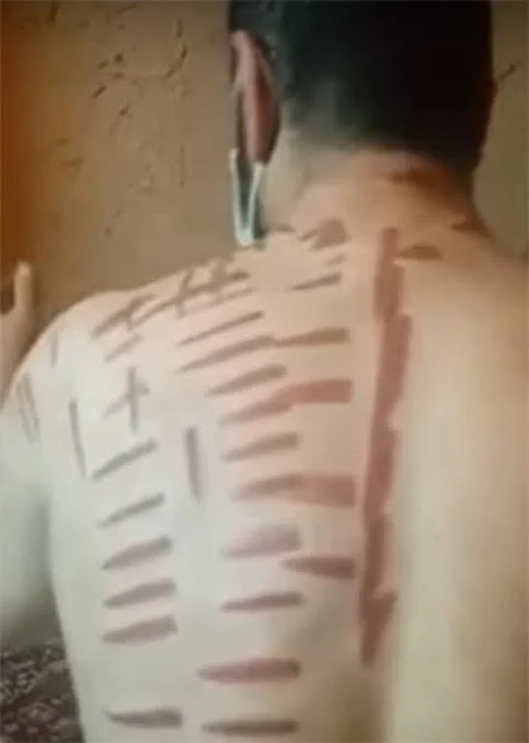 ضحية المعالج الشعبي بالقصيم يحكي لـ "سبق" تفاصيل تشويه جسده