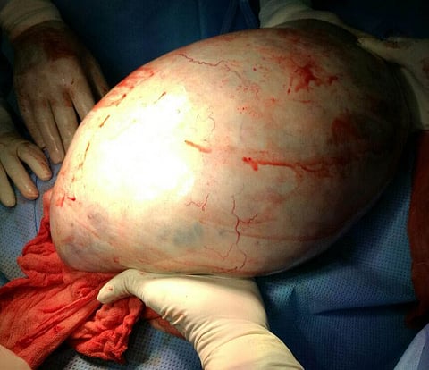 شاهد .. استئصال ورم يزن 10 كيلو من بطن عشرينية بالرياض