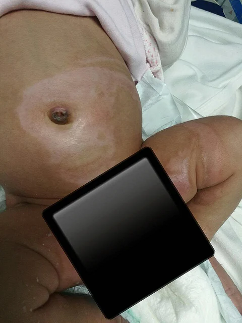 مواطن يطالب بمعرفة المتسبب في حرق مولوده بمستشفى الولادة بحائل