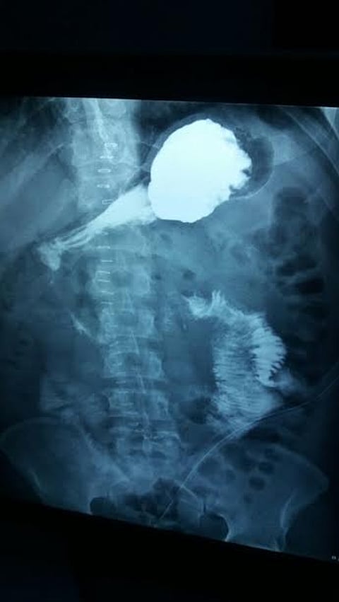 استئصال ورم نادر لمقيم بعرعر في مستشفى "ابن مساعد"