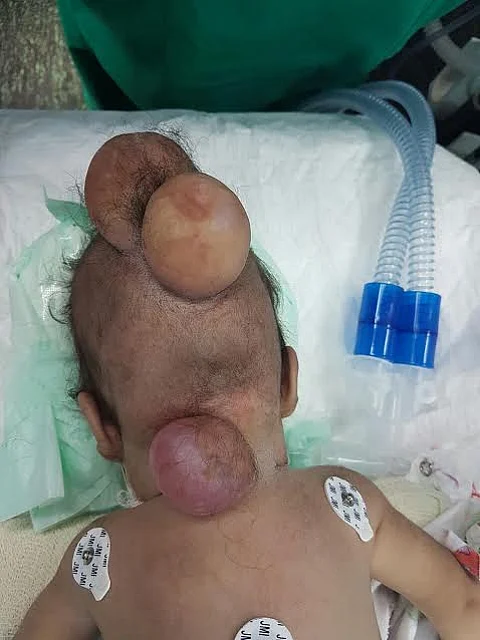 نجاح جراحة نادرة بمخ رضيع في مستشفى الملك سلمان