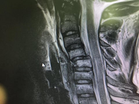 نجاح جراحة معقدة بالفقرات والحبل الشوكي لشاب بمستشفى الحفر