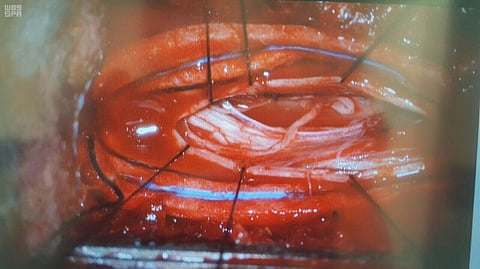 نجاح عملية لاستئصال زائدة دودية بطول ٢٠سم بمستشفى صامطة