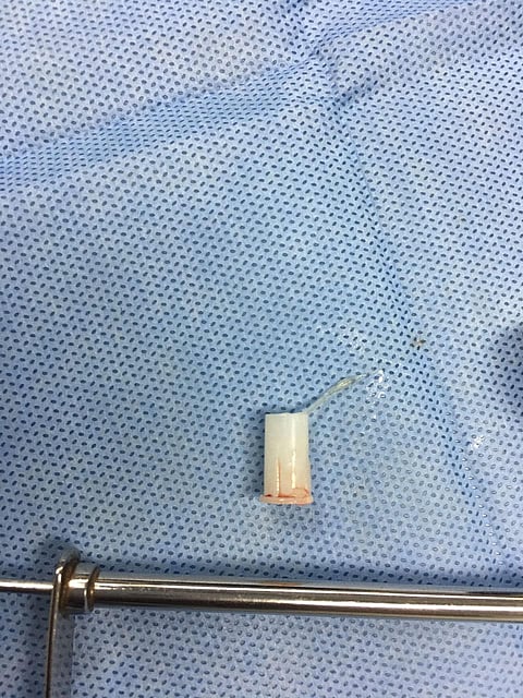 المدينة.. جراحة ناجحة لطفل ابتلع "صفارة" استقرت في القصبة الهوائية