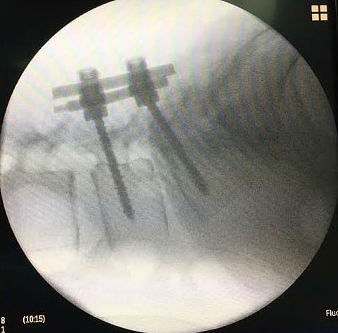 فريق طبي يتحدى سمنة مريضة بحفر الباطن ويثبت فقراتها القطنية