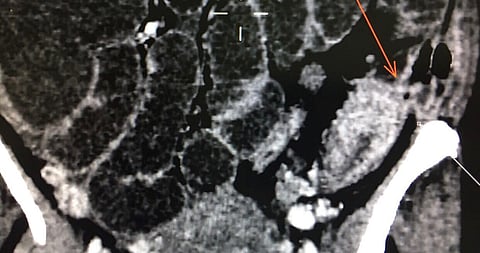 فريق متخصص في "سعود الطبية" ينهي معاناة أربعينية من انفجار "القولون السيني"